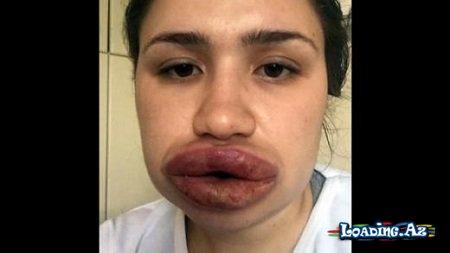 Həkimin dəhşətli vəziyyətə saldığı qız sağaldı – FOTO - Sun.Az