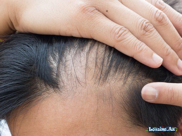 Alopesiya – Saç tökülməsi - Sun.Az