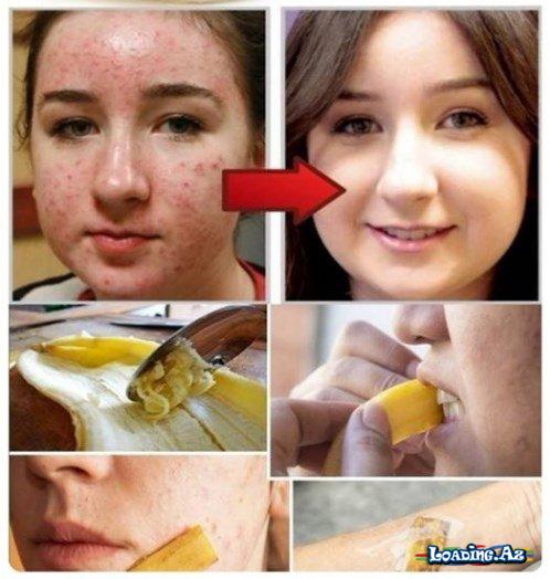 Banan qabığı ilə, ləkələrə, sızanaqlara, qırışlara, ziyillərə, yaralara son+101 faydası - Sun.Az