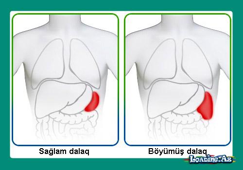 Dalağın böyümə səbəbləri
