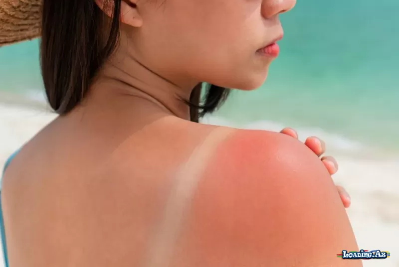 Sadəcə bir günəş yanığı sağlamlığınızı həmişəlik dəyişdirə bilər - Sun.Az